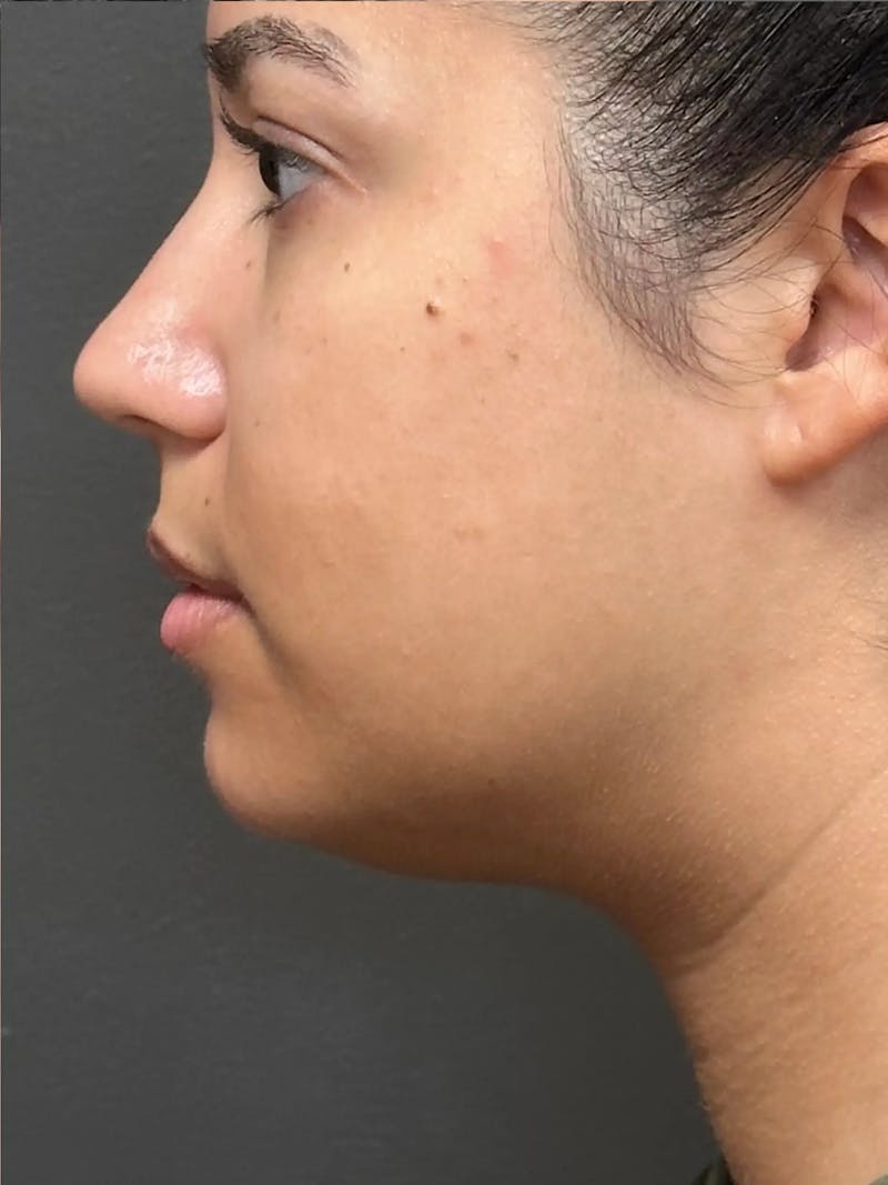 Chin Filler Before & After Gallery - Patient 111130 - Image 5
