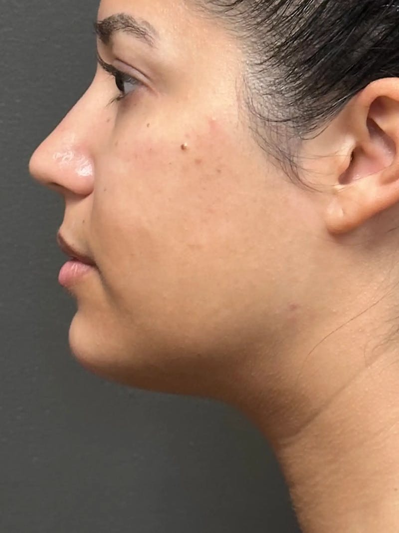 Chin Filler Before & After Gallery - Patient 111130 - Image 6