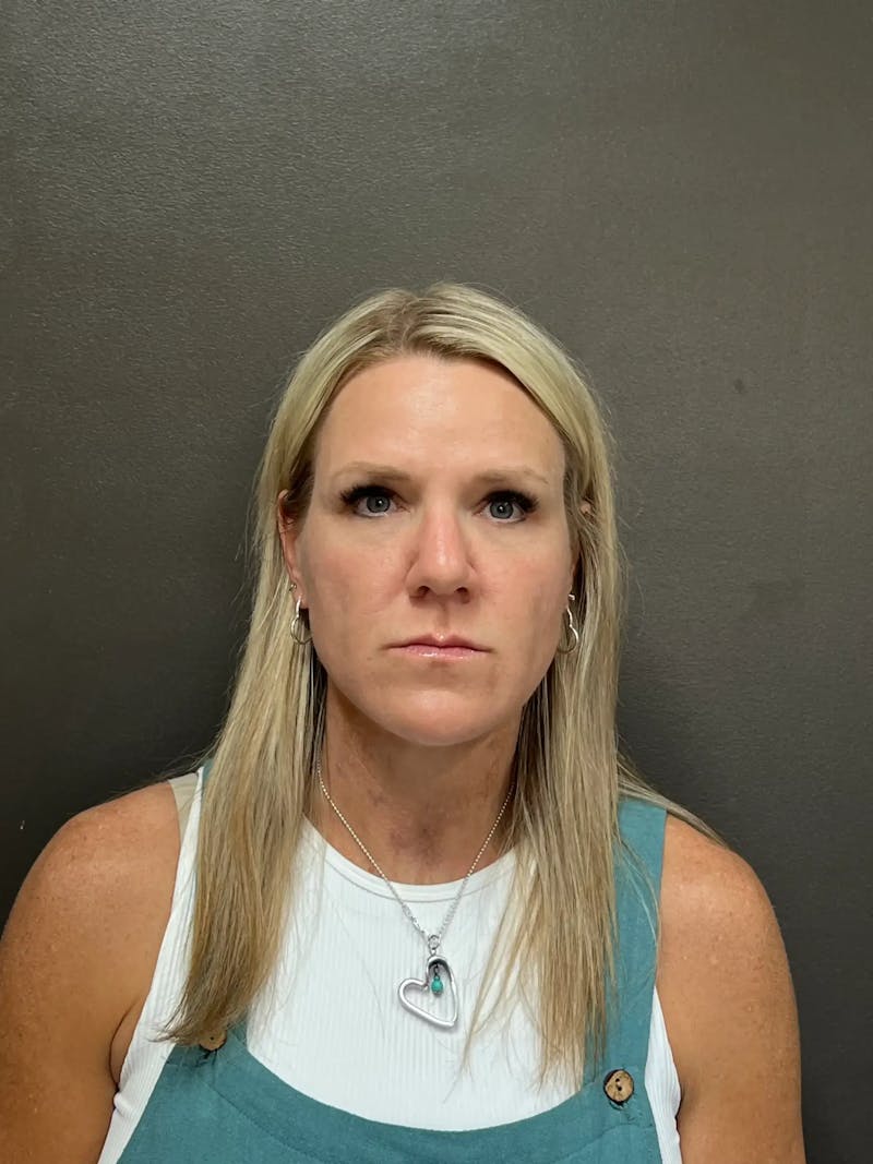 Cheek Filler Before & After Gallery - Patient 387273 - Image 1