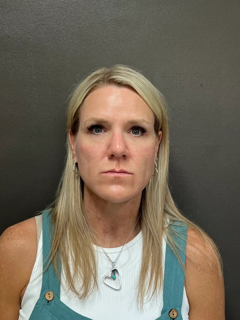 Cheek Filler Before & After Gallery - Patient 387273 - Image 2