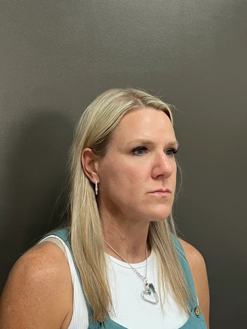 Cheek Filler Before & After Gallery - Patient 387273 - Image 3