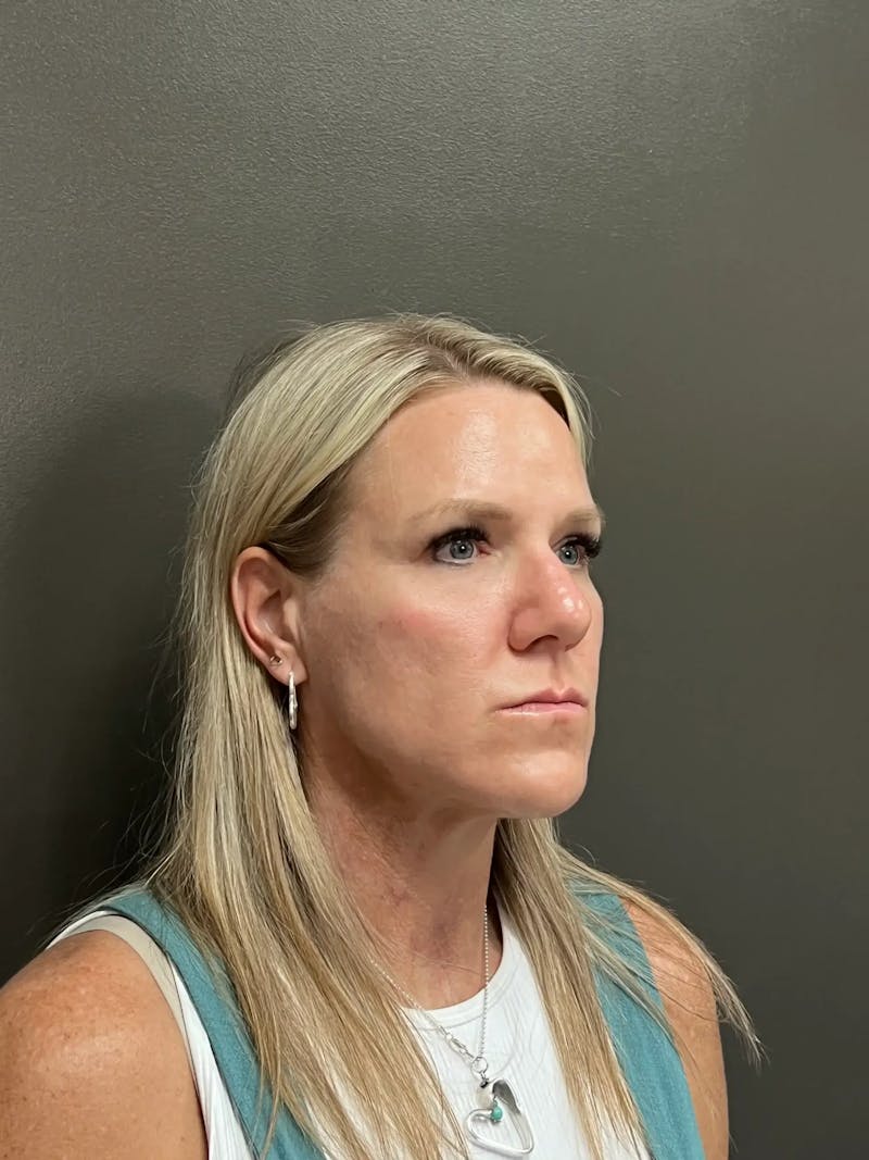 Cheek Filler Before & After Gallery - Patient 387273 - Image 4