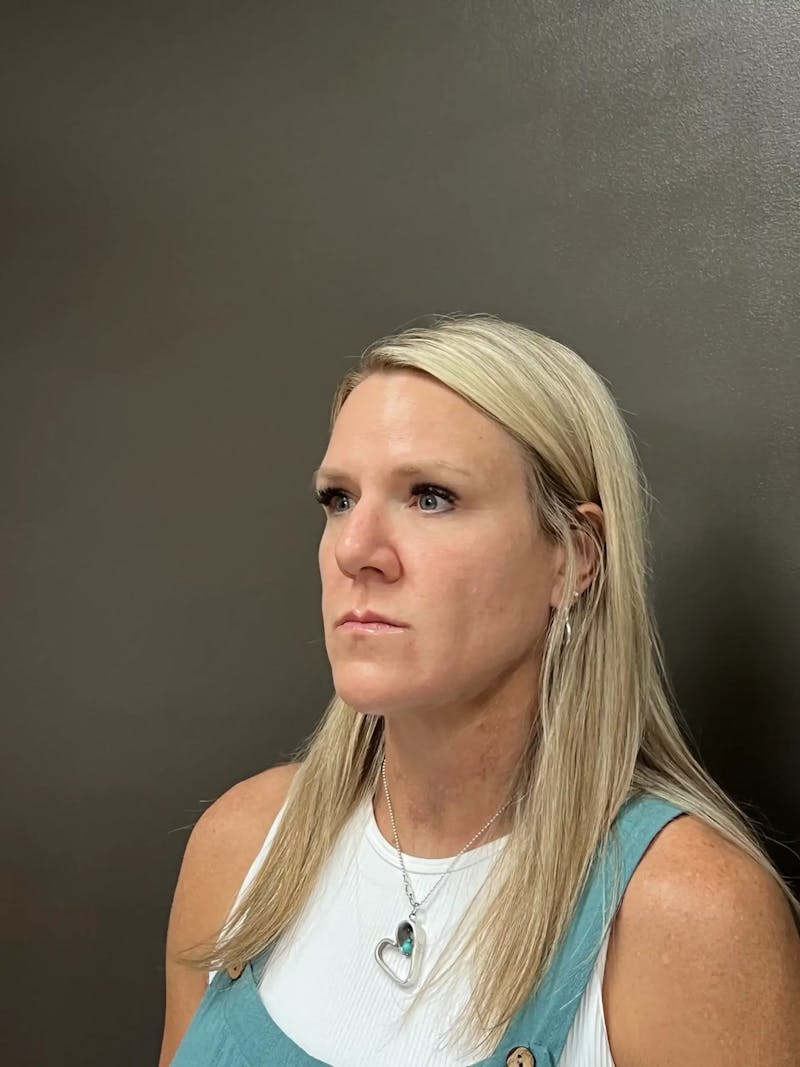 Cheek Filler Before & After Gallery - Patient 387273 - Image 5