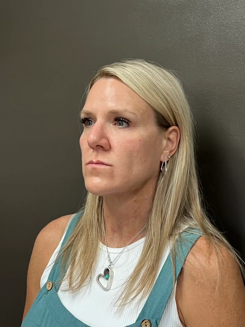 Cheek Filler Before & After Gallery - Patient 387273 - Image 6