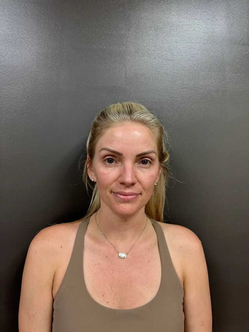 Cheek Filler Before & After Gallery - Patient 403101 - Image 1