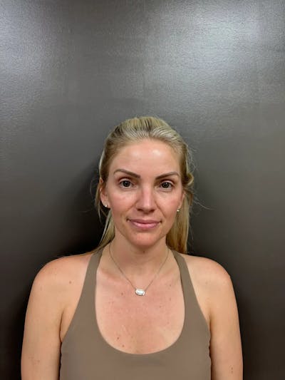 Cheek Filler Before & After Gallery - Patient 403101 - Image 1