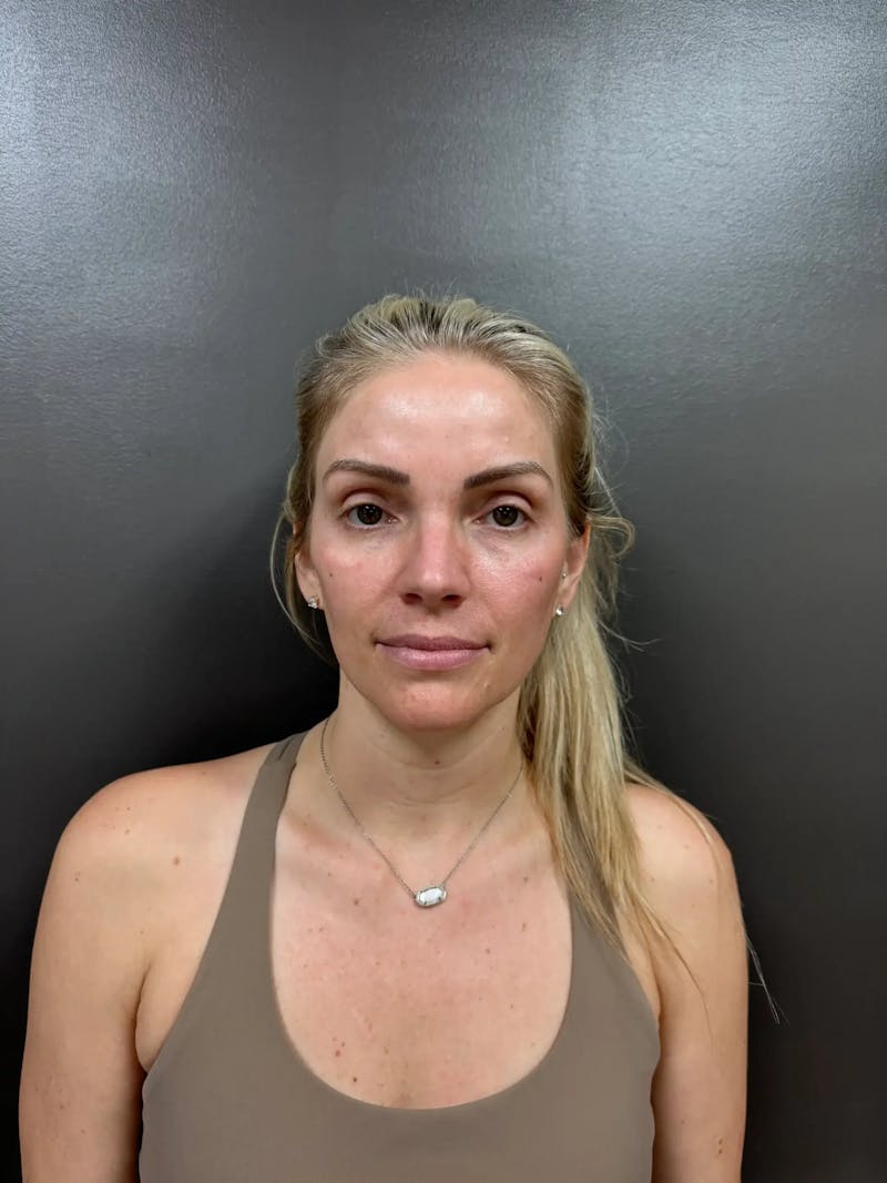 Cheek Filler Before & After Gallery - Patient 403101 - Image 2