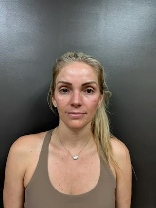 Cheek Filler Before & After Gallery - Patient 403101 - Image 2