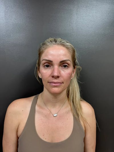 Cheek Filler Before & After Gallery - Patient 403101 - Image 2