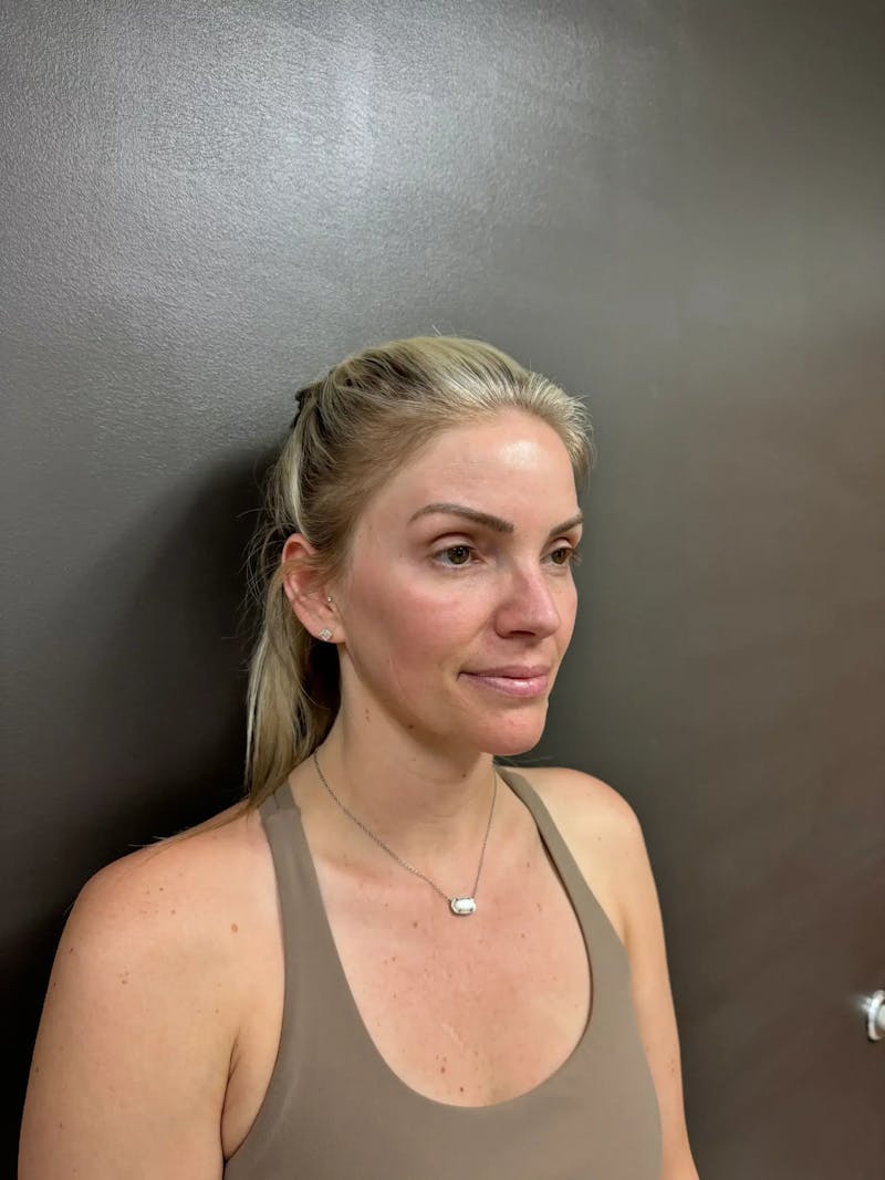 Cheek Filler Before & After Gallery - Patient 403101 - Image 3