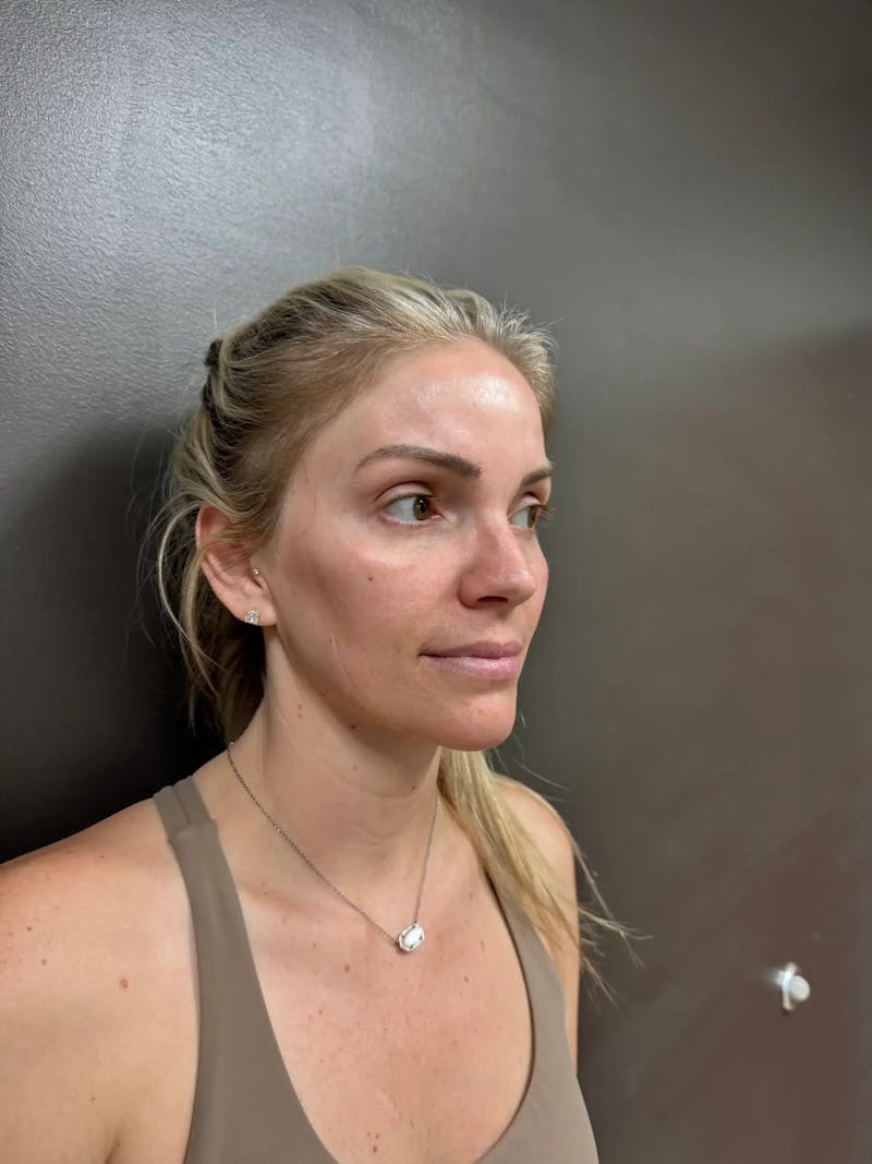 Cheek Filler Before & After Gallery - Patient 403101 - Image 4