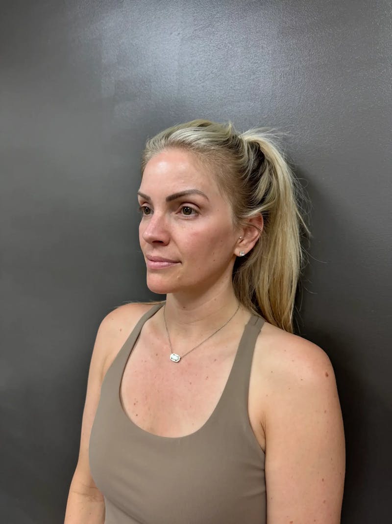 Cheek Filler Before & After Gallery - Patient 403101 - Image 5