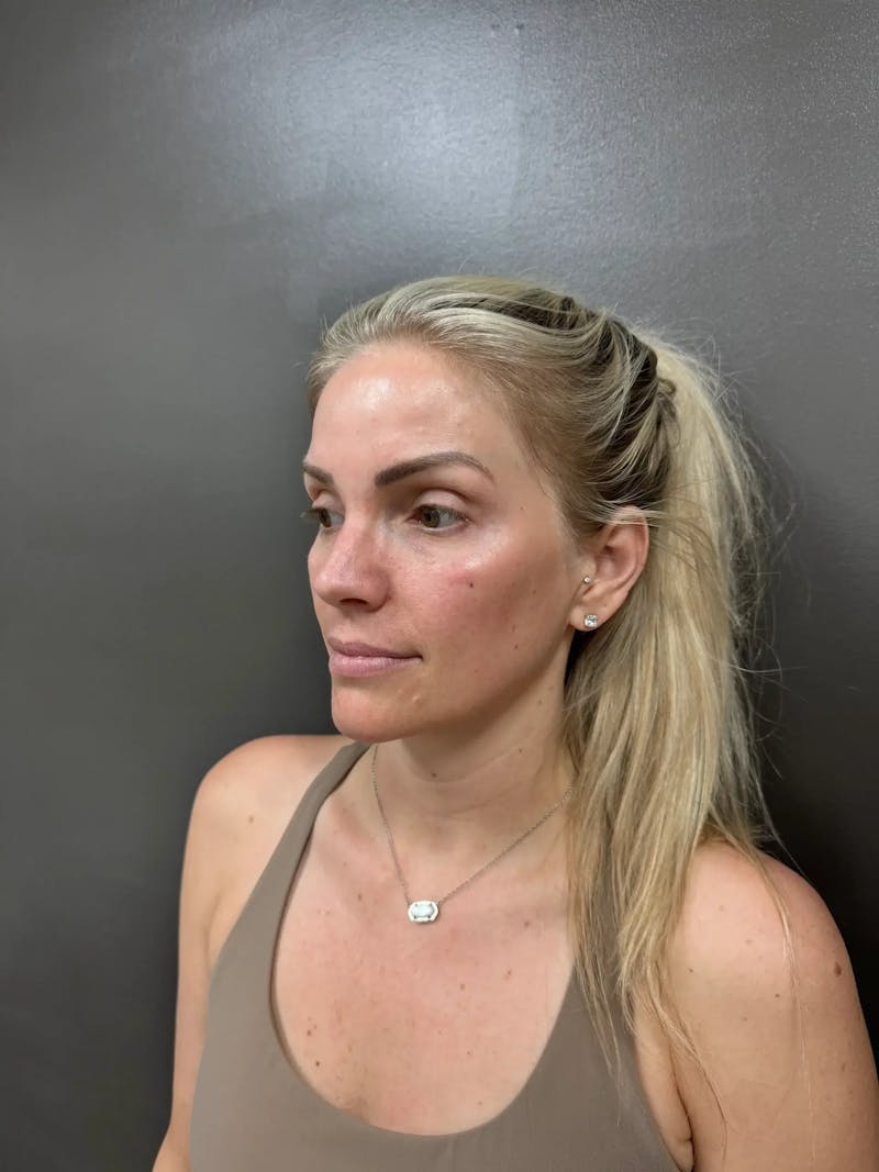 Cheek Filler Before & After Gallery - Patient 403101 - Image 6