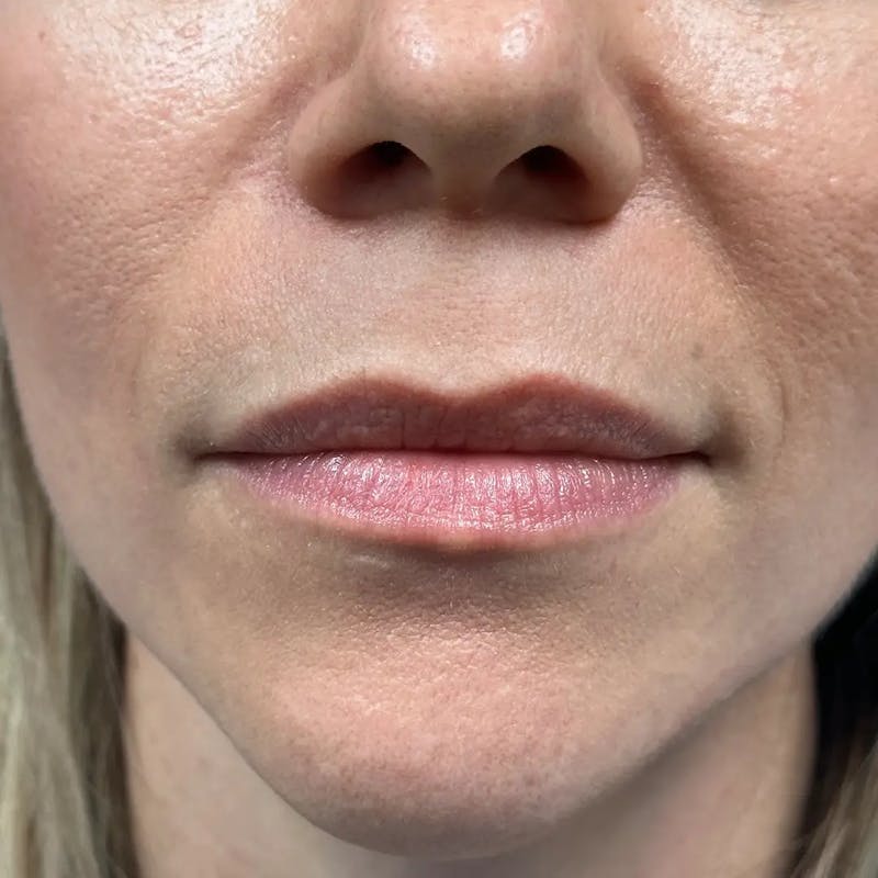 Lip Filler Before & After Gallery - Patient 120308 - Image 1