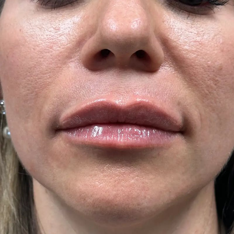 Lip Filler Before & After Gallery - Patient 120308 - Image 2