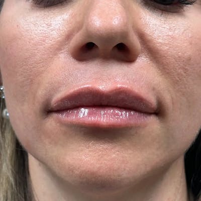 Lip Filler Before & After Gallery - Patient 120308 - Image 2