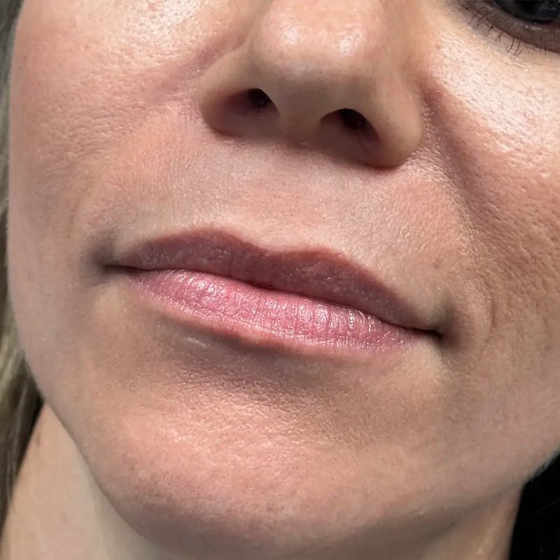 Lip Filler Before & After Gallery - Patient 120308 - Image 3