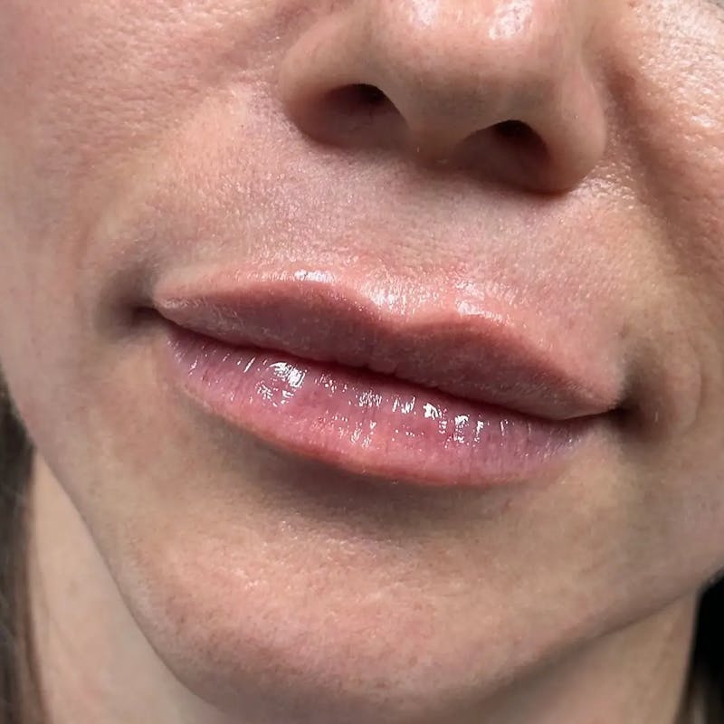 Lip Filler Before & After Gallery - Patient 120308 - Image 4