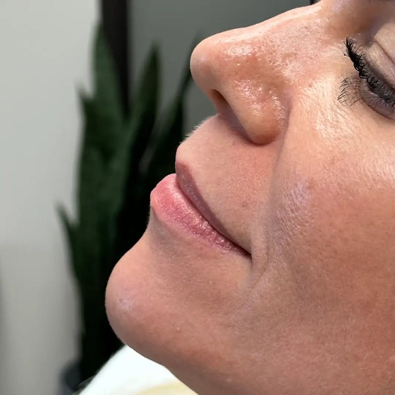 Lip Filler Before & After Gallery - Patient 120308 - Image 5