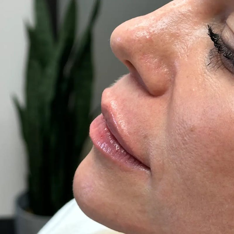 Lip Filler Before & After Gallery - Patient 120308 - Image 6