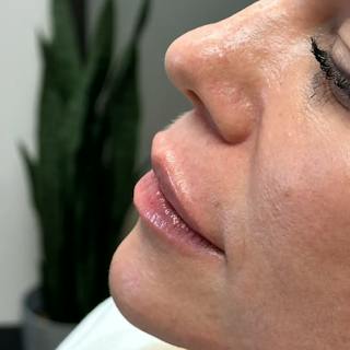 Lip Filler Before & After Gallery - Patient 120308 - Image 6