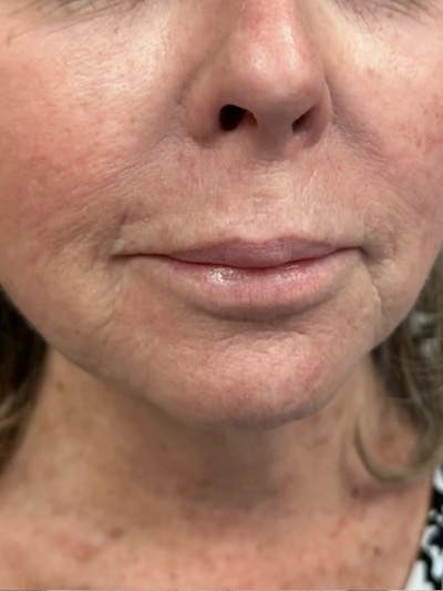 Lip Filler Before & After Gallery - Patient 182860 - Image 1