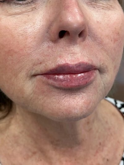 Lip Filler Before & After Gallery - Patient 182860 - Image 2