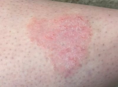 Laser Treatment Before & After Gallery - Patient 381893 - Image 1