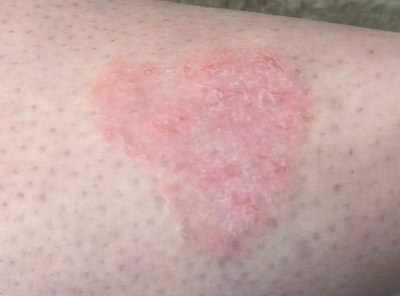 Laser Treatment Before & After Gallery - Patient 381893 - Image 1