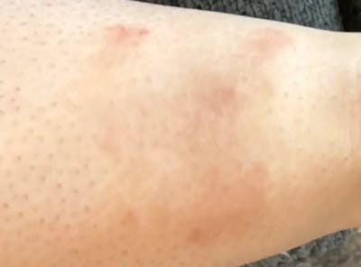 Laser Treatment Before & After Gallery - Patient 381893 - Image 2