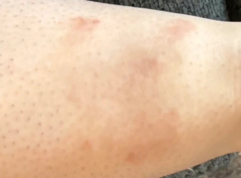 Laser Treatment Before & After Gallery - Patient 381893 - Image 2