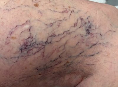 Laser Treatment Before & After Gallery - Patient 181605 - Image 1