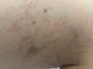 Laser Treatment Before & After Gallery - Patient 181605 - Image 2