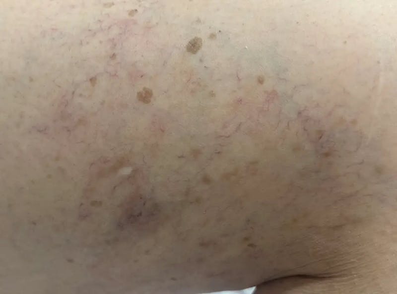 Laser Treatment Before & After Gallery - Patient 181605 - Image 2