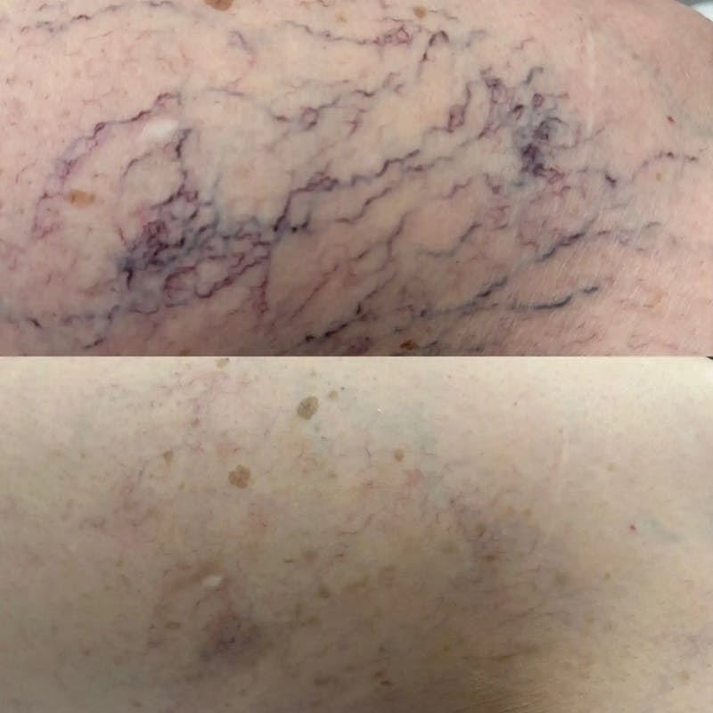 Laser Treatment Before & After Gallery - Patient 181605 - Image 3