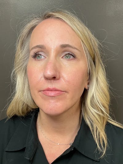 Laser Treatment Before & After Gallery - Patient 179138 - Image 1