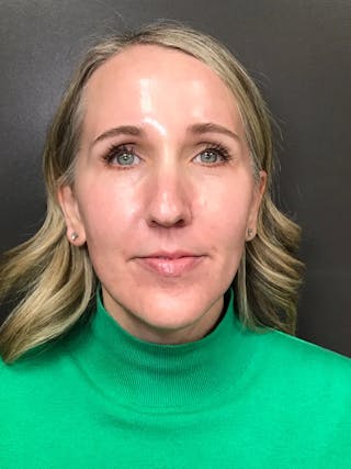 Laser Treatment Before & After Gallery - Patient 179138 - Image 2