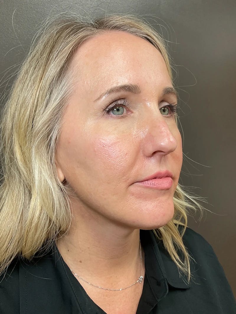 Laser Treatment Before & After Gallery - Patient 179138 - Image 3