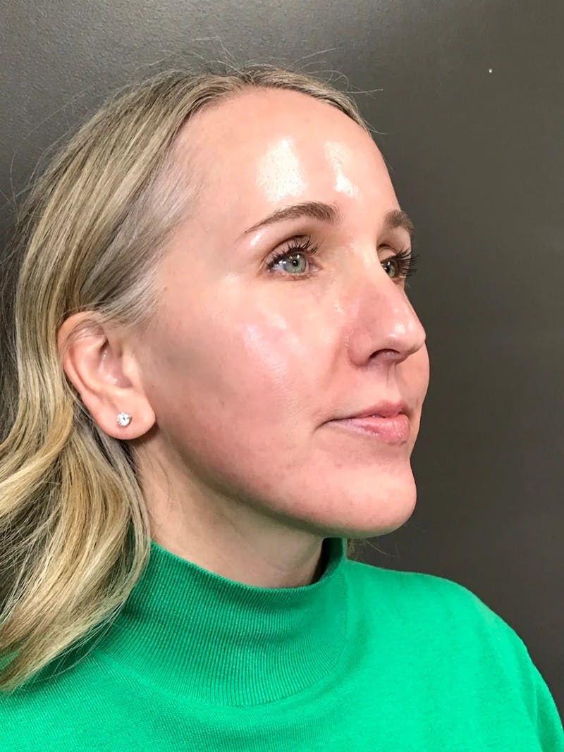 Laser Treatment Before & After Gallery - Patient 179138 - Image 4