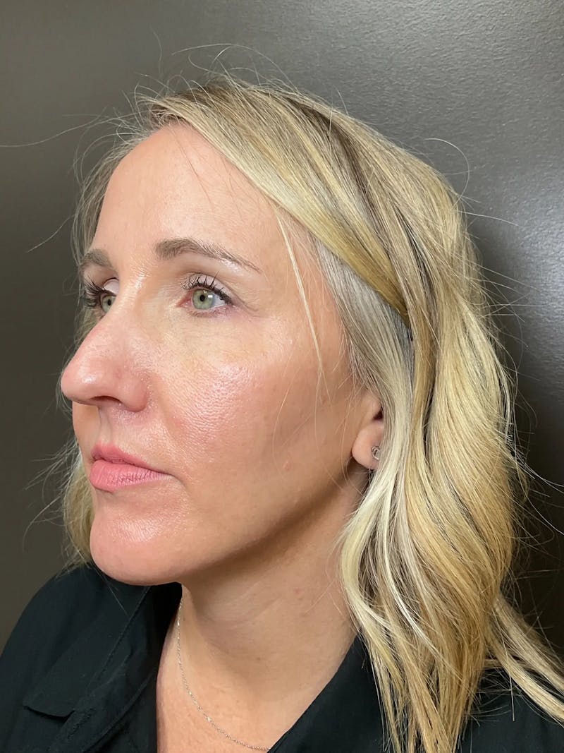 Laser Treatment Before & After Gallery - Patient 179138 - Image 5