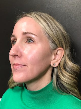 Laser Treatment Before & After Gallery - Patient 179138 - Image 6