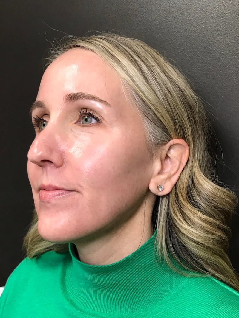 Laser Treatment Before & After Gallery - Patient 179138 - Image 6