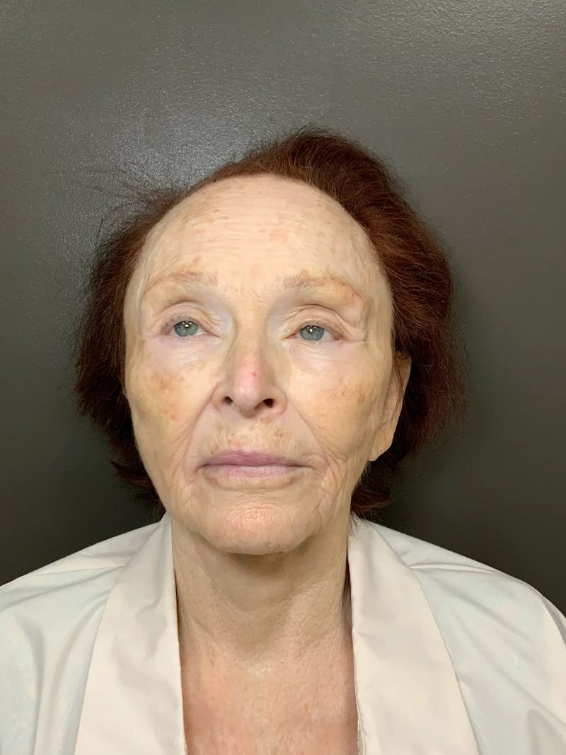 Laser Treatment Before & After Gallery - Patient 284018 - Image 1