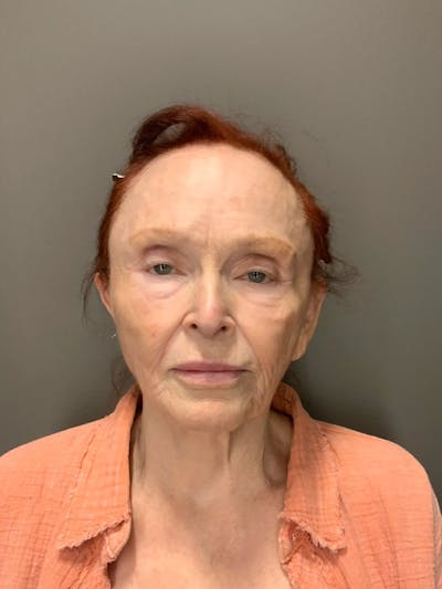 Laser Treatment Before & After Gallery - Patient 284018 - Image 2