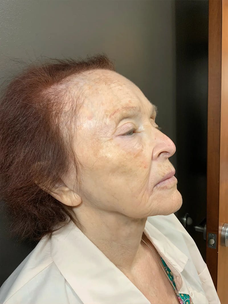 Laser Treatment Before & After Gallery - Patient 284018 - Image 3