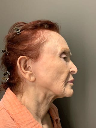 Laser Treatment Before & After Gallery - Patient 284018 - Image 4