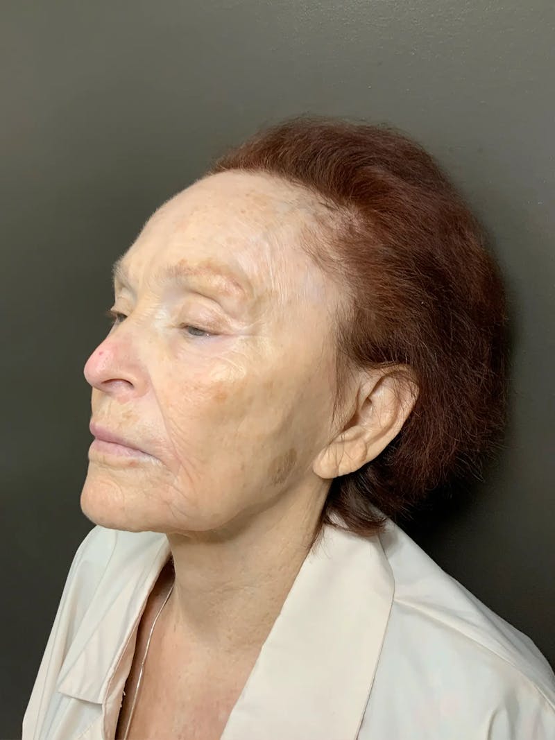 Laser Treatment Before & After Gallery - Patient 284018 - Image 5
