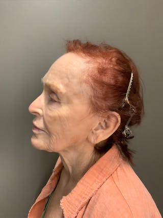 Laser Treatment Before & After Gallery - Patient 284018 - Image 6