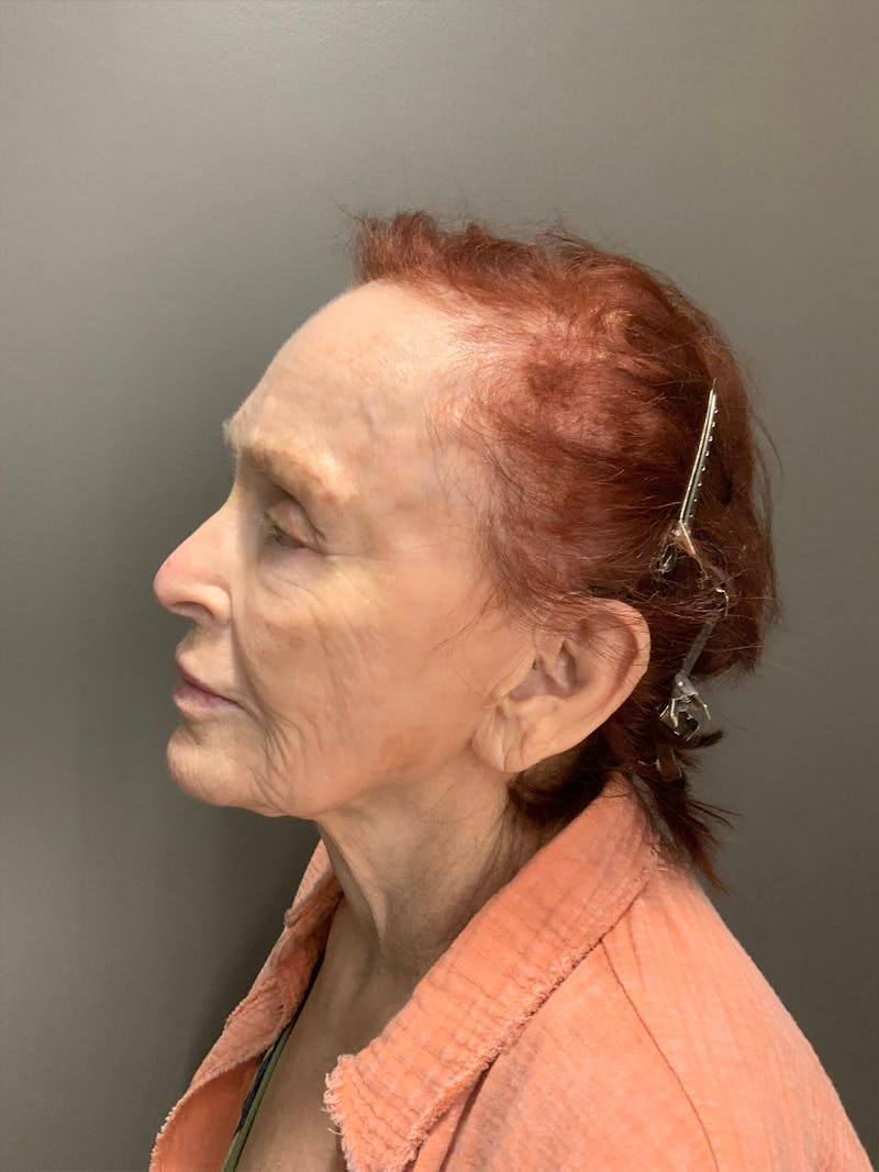 Laser Treatment Before & After Gallery - Patient 284018 - Image 6