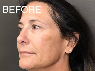 Laser Treatment Before & After Gallery - Patient 381798 - Image 1